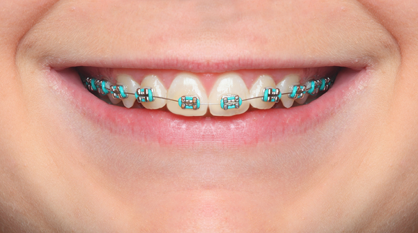 Affordable Braces for Adults Atlanta