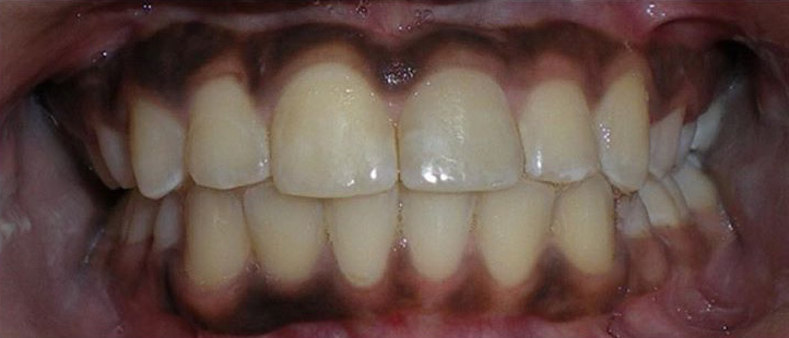 Braces and Invisalign® Before and After Pictures Atlanta & Marietta, GA