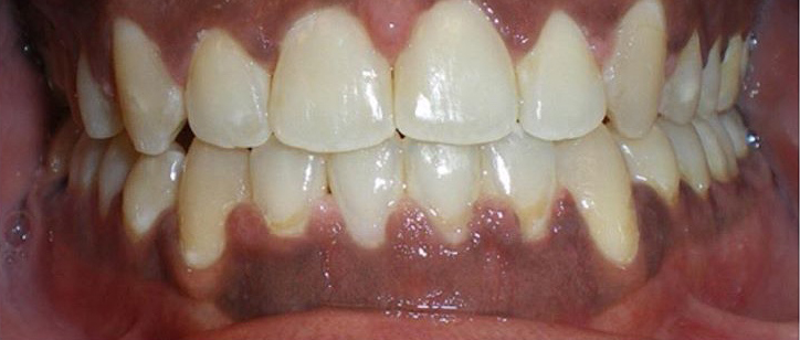 Braces and Invisalign® Before and After Pictures Atlanta & Marietta, GA